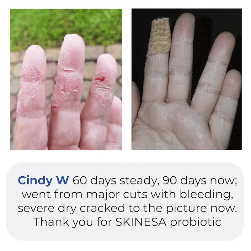 Skinesa® Skin Probiotic